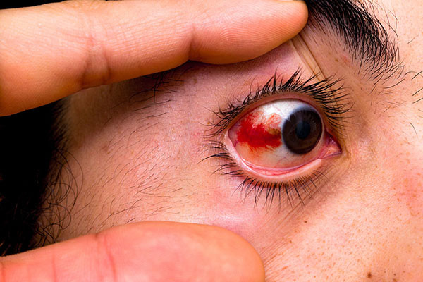 Vỡ mạch máu trong mắt là gì Tìm hiểu chung về bệnh vỡ mạch máu trong mắt 3