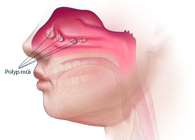Polyp mũi là những mô phát triển bất thường có thể gây tắc nghẽn xoang mũi (Ảnh: Internet)