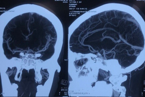 Cô gái 29 tuổi bị liệt nửa người do chảy máu não: Bác sĩ chỉ ra ba nguyên nhân gây đột quỵ ở người trẻ - Ảnh 3.