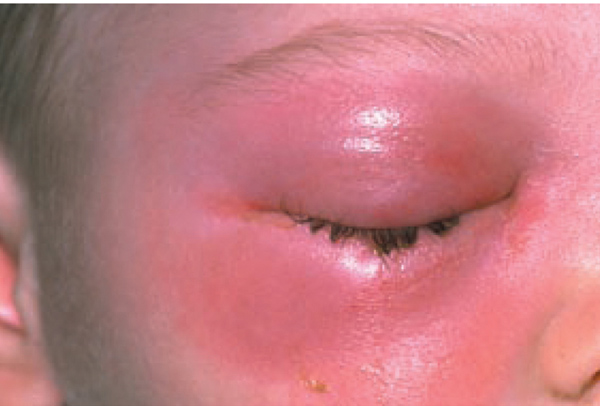 Sưng mắt là dấu hiệu nhiễm trùng nghiêm trọng của viêm xoang cấp tính (Ảnh: Internet)