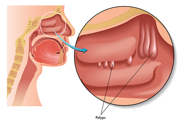 Polyp mũi xoang là một trong số các yếu tố nguy cơ gây nên viêm xoang mạn tính (Ảnh: Internet)