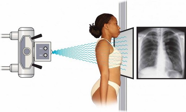 Ứng dụng X-Quang và CT-Scaner trong chẩn đoán COPD - Ảnh 1.