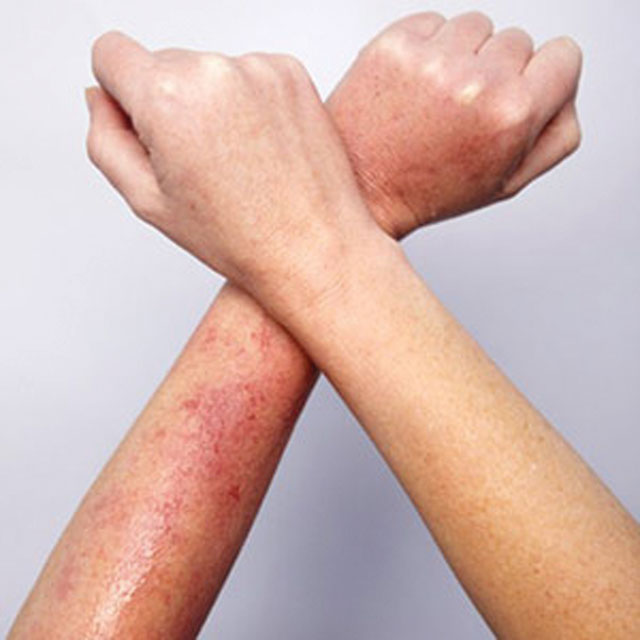 Bệnh về da mùa mưa: Nhiễm khuẩn da và bệnh da do ký sinh trùng - Ảnh 2.