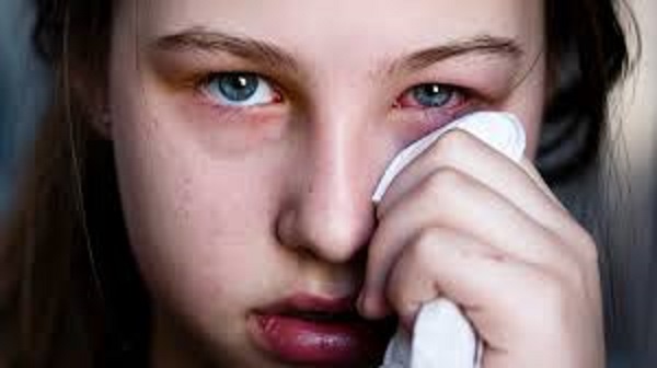 Sai lầm khi chăm sóc người bị đau mắt đỏ khiến tình trạng bệnh trở nên nặng hơn - Ảnh 2.