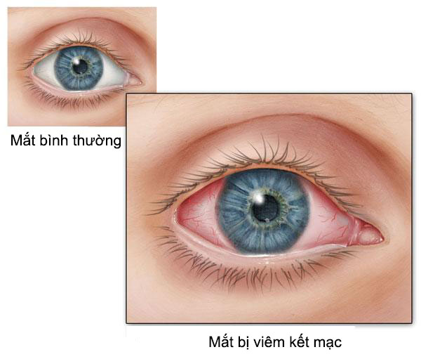 Dấu hiệu của bệnh đau mắt đỏ ở trẻ nhỏ bạn không nên bỏ qua - Ảnh 2.