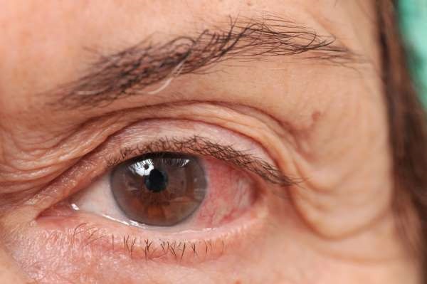 Các hướng dẫn chăm sóc giảm nhẹ triệu chứng đau mắt đỏ mà người bệnh nhất định phải biết - Ảnh 1.