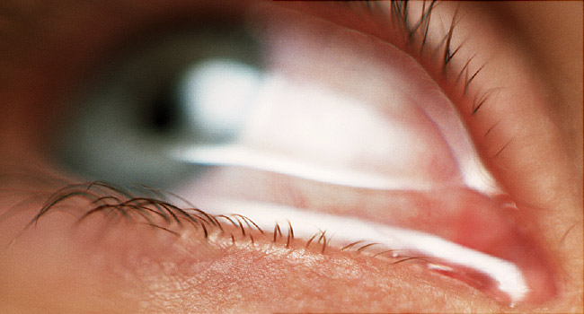 Các hướng dẫn chăm sóc giảm nhẹ triệu chứng đau mắt đỏ mà người bệnh nhất định phải biết - Ảnh 3.