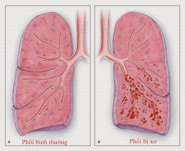 Phân biệt COPD và các bệnh về phổi dễ bị nhầm lẫn - Ảnh 2.