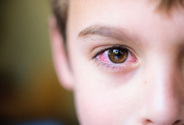 Tổng hợp các đường lây nhiễm đau mắt đỏ: Nhìn vào mắt người đau mắt đỏ có bị lây bệnh không?  - Ảnh 2.