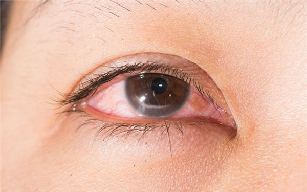 Những biện pháp phòng tránh bệnh đau mắt đỏ khi có dịch người bệnh cần biết