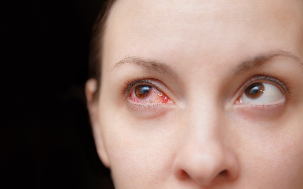 Những kiến thức cần biết về thuốc điều trị đau mắt đỏ cho phụ nữ mang thai?