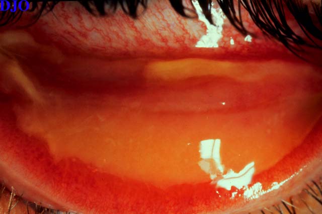 dấu hiệu bệnh đau mắt đỏ chuyển nặng giả mạc