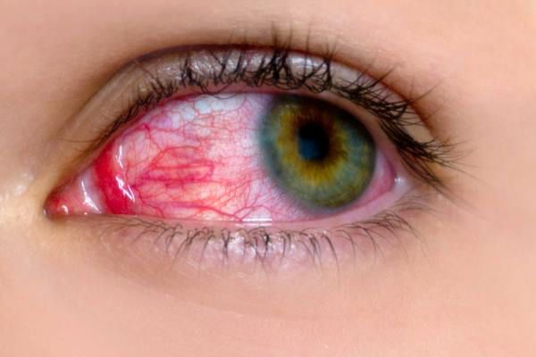 giả mạc triệu chứng của bệnh đau mắt đỏ