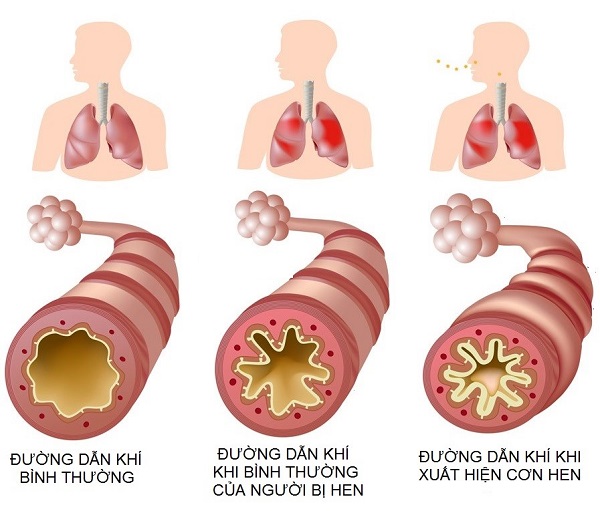 Mối liên hệ giữa COPD và hen suyễn ở trẻ em như thế nào? - Ảnh 2.
