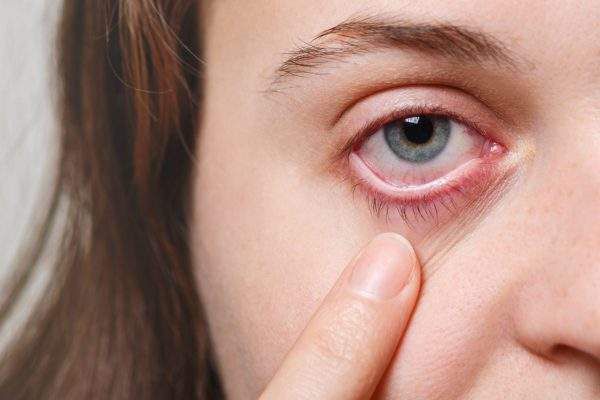 Đau mắt đỏ: Những biện pháp phòng tránh lây nhiễm từ người bệnh  - Ảnh 3.