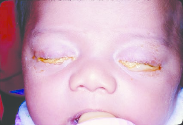 Biến chứng đau mắt đỏ gây viêm màng não ở trẻ: Không phổ biến nhưng nguy hiểm! - Ảnh 1.