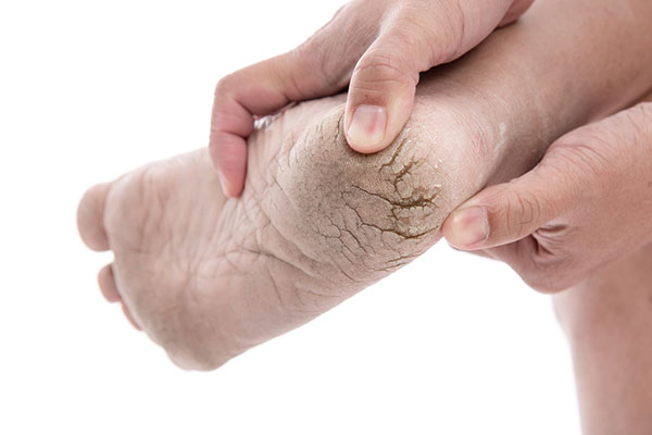Nứt gót chân mùa hanh khô: Bệnh về da phổ biến nhưng không phải ai cũng biết cách đối phó - Ảnh 3.