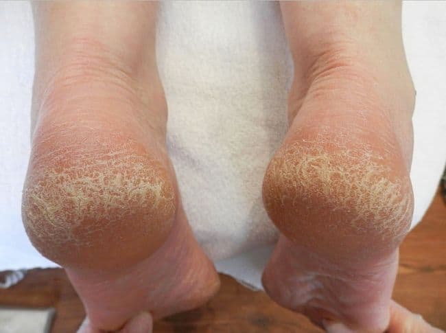 Nứt gót chân mùa hanh khô: Bệnh về da phổ biến nhưng không phải ai cũng biết cách đối phó - Ảnh 2.