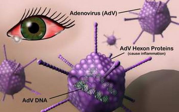 Bệnh viêm kết mạc do virus (đau mắt đỏ do virus) là gì? 