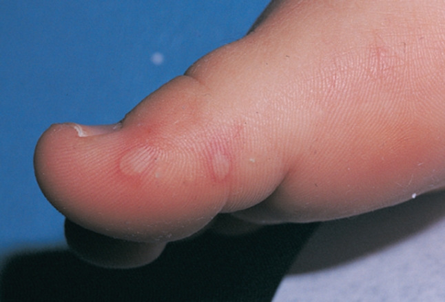 Bác sĩ Nhi đồng hướng dẫn nhận diện chính xác dấu hiệu bệnh tay chân miệng theo giai đoạn - Ảnh 3.