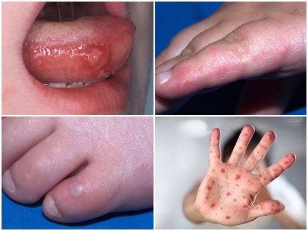 Bệnh tay chân miệng ở trẻ em và cách phòng tránh nguy cơ lây nhiễm tại trường học - Ảnh 1.