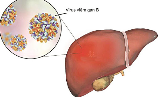 Virus viêm gan B có thể tiến triển thành bệnh xơ gan nếu không phát hiện sớm - Ảnh 3.