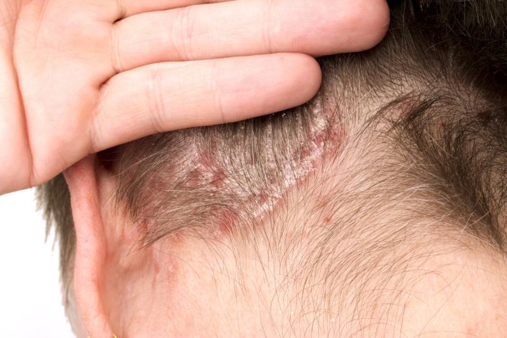 Nhận biết nhanh các dấu hiệu bệnh nấm da và cách điều trị hiệu quả - Ảnh 6.