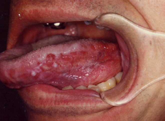 Đau rát lưỡi - biểu hiện của nhiều bệnh nguy hiểm không được chủ quan! - Ảnh 5. bị rát lưỡi