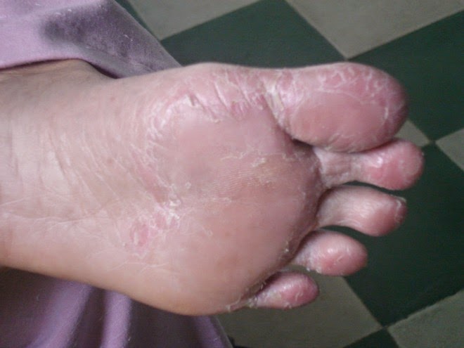 Bong da chân: Hiện tượng tróc da bàn chân nguyên nhân và cách khắc phục