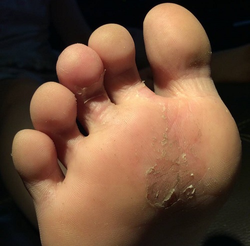 Bong da chân: Hiện tượng tróc da bàn chân nguyên nhân và cách khắc phục - Ảnh 2.