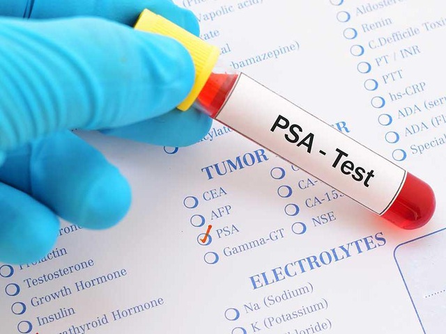 Những ai cần làm xét nghiệm PSA ung thư tuyến tiền liệt? - Ảnh 3.