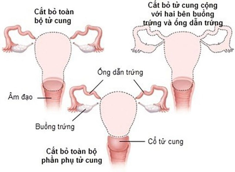hậu quả của việc cắt bỏ tử cung