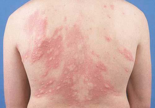 Cẩn trọng với một số căn bệnh về da thường gặp vào mùa hè  - Ảnh 4.