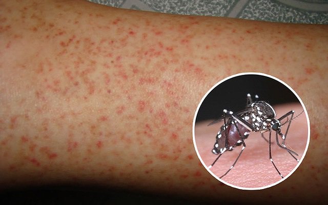 Nhận biết và phân biệt sớm sốt xuất huyết với sốt phát ban - Ảnh 4.