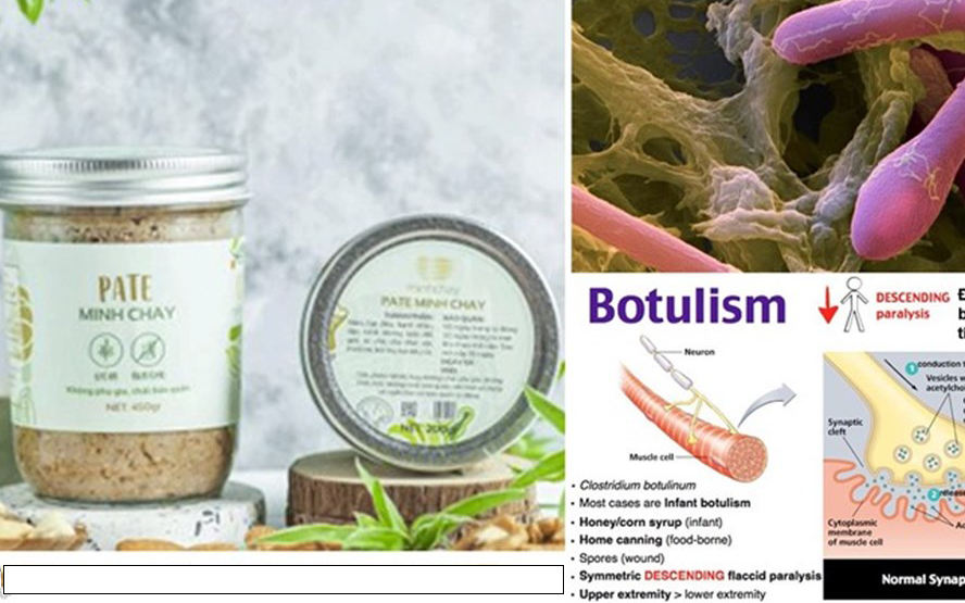 TS. Nguyễn Hồng Vũ: “Vi khuẩn Clostridium botulinum có trong Pate Minh Chay gây ngộ độc hiếm gặp nhưng rất nguy hiểm”