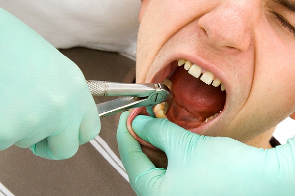 Ảnh hưởng của nhổ răng lên hệ thần kinh  - Ảnh 2.
