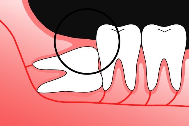 Ảnh hưởng của nhổ răng lên hệ thần kinh  - Ảnh 1.