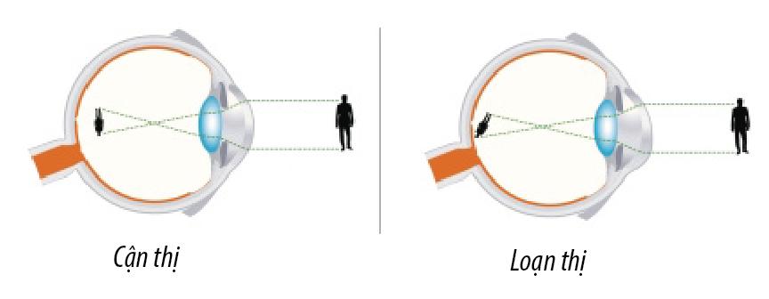 phân biệt cận thị và loạn thị