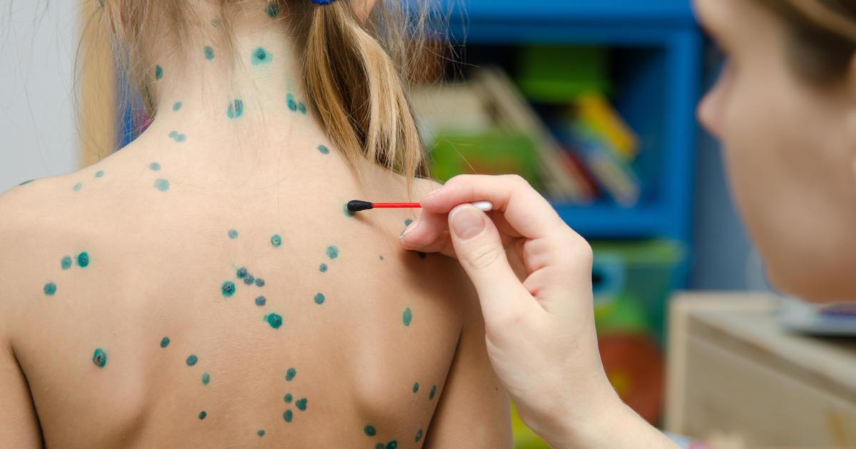 Khi nào nên bôi xanh methylen chữa bệnh thủy đậu? - Ảnh 3.