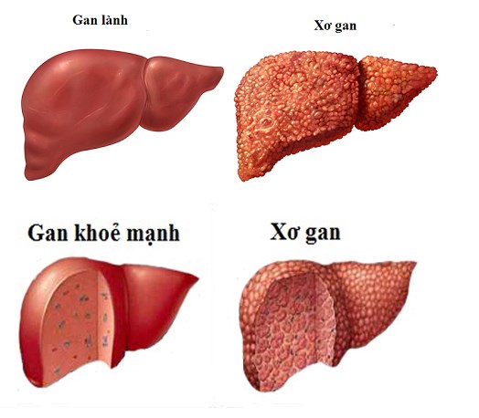 So sánh hình ảnh gan bình thường và gan của bệnh nhân xơ gan (Ảnh: Internet)