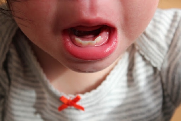 Cha mẹ cần biết gì về tình trạng viêm nướu răng ở trẻ em? - Ảnh 4.