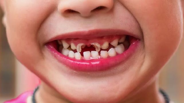 Sâu răng ở trẻ em là gì? Điều trị sâu răng ở trẻ em bằng cách nào? - Ảnh 3.