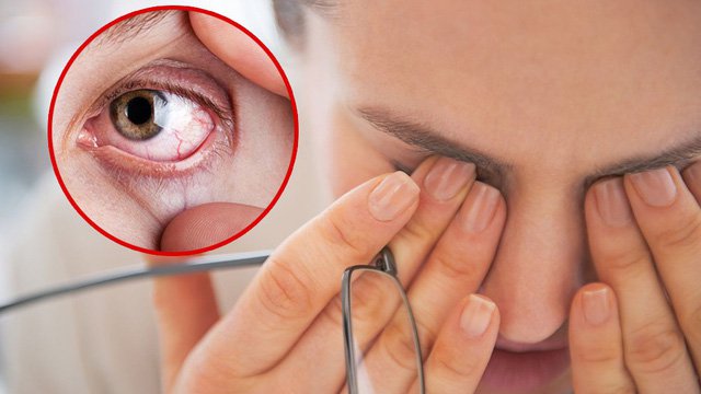 Mắt bị ngứa: Nguyên nhân và cách điều trị - Ảnh 2.