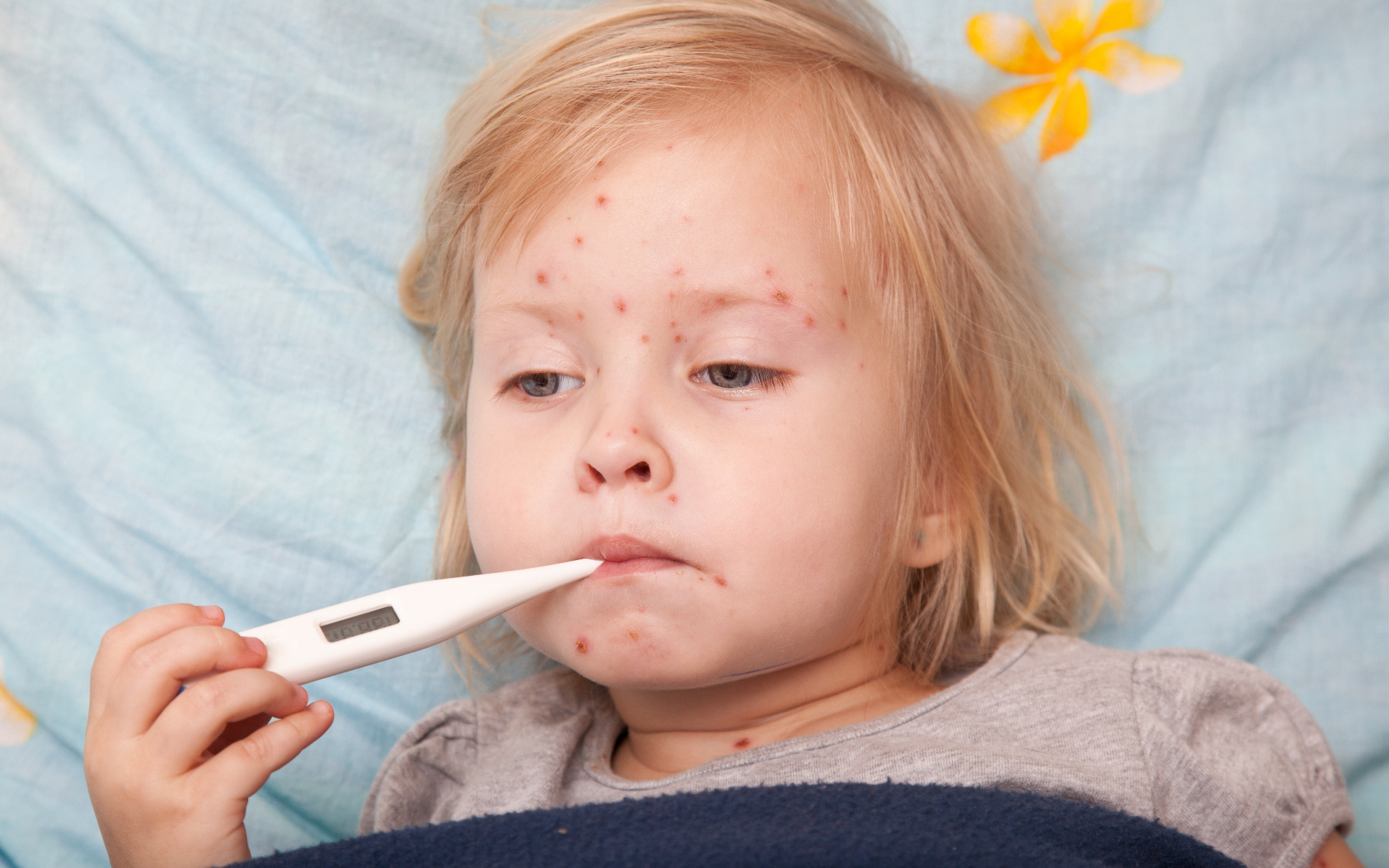 Tổng hợp các các dụng phụ của vắc xin quai bị mà cha mẹ nên biết