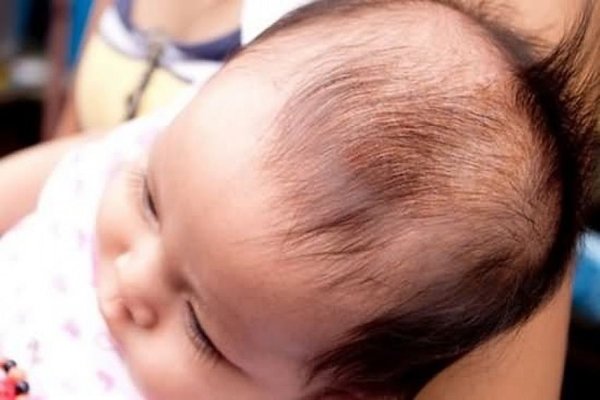 Vị trí rụng tóc ở trẻ sơ sinh và nguyên nhân nào gây rụng tóc ở trẻ? - Ảnh 2.