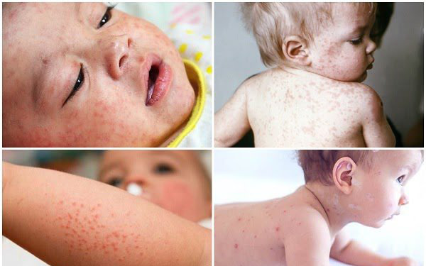 Mắc bệnh Rubella phải kiêng tắm gội không? 