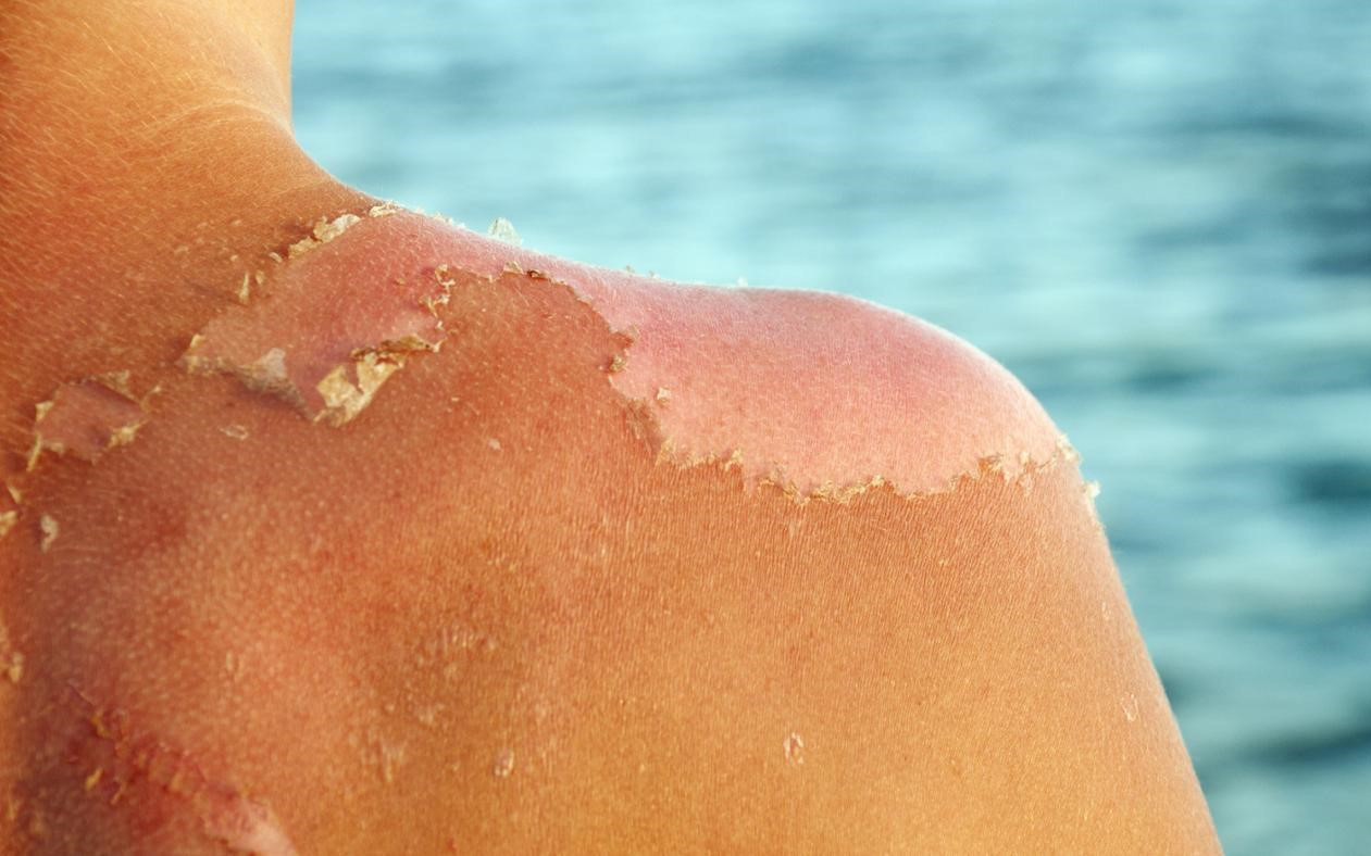 Chuyên gia cảnh báo da bị "cháy nắng" có thể gây ung thư da