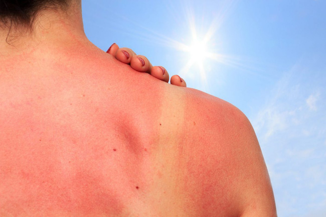 Nắng nóng mùa hè: Chuyên gia cảnh báo da bị &quot;cháy nắng&quot; có thể gây ung thư da - Ảnh 4.