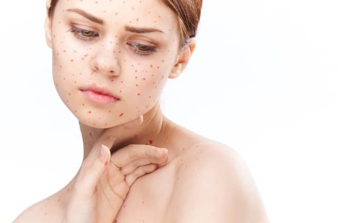 Bệnh Rubella bao lâu thì khỏi? 