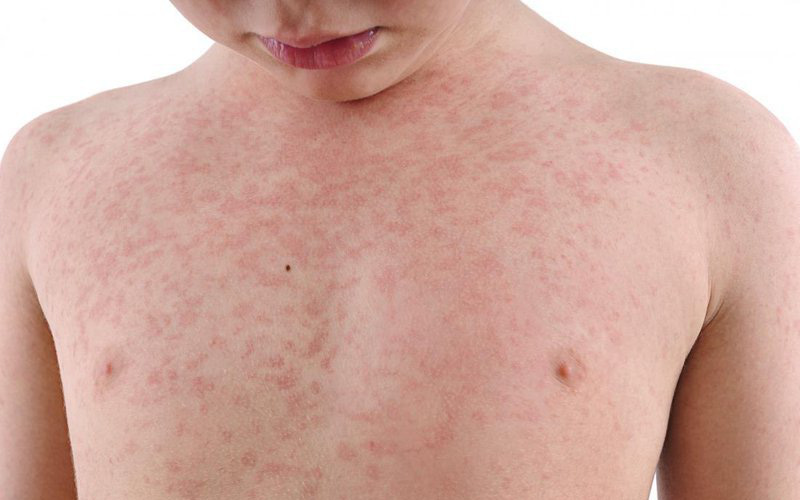 Chế độ ăn uống khi bị Rubella: Người bệnh cần lưu ý gì?